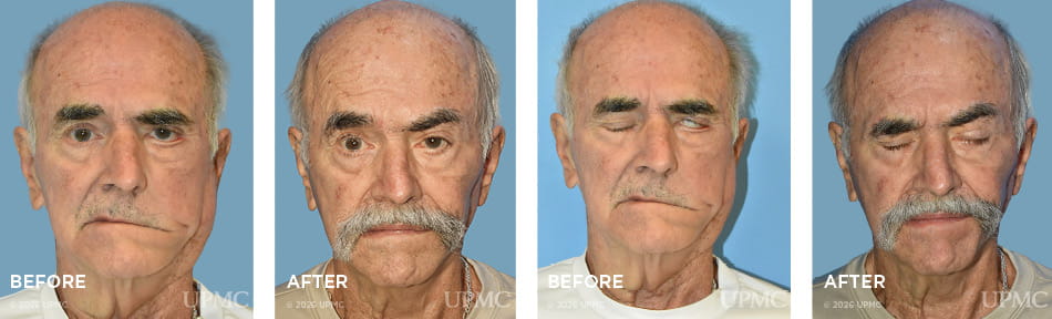 Patient with eyes open and closed, with flaccid facial paralysis before fascia lata static suspension, left brow lift, left eyelid weight, left lower lid tightening.